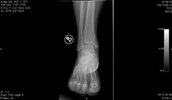 Ankle-joint.webp
