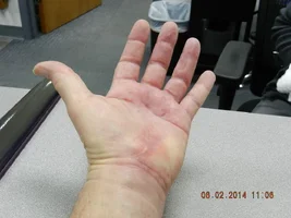 Surgery + 8 weeks.webp