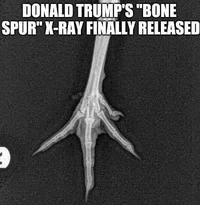 donald-trumps-bone-spur.webp