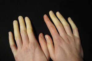 raynauds-phenomenon-3761511922.jpg